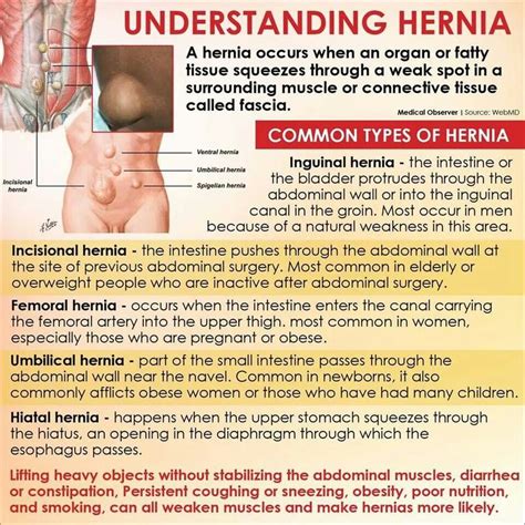 Understanding Hernia Hernia Inguinal Abdominal Bladder