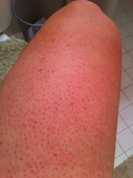 Flat Pinpoint Red Dots On Skin Senturingray