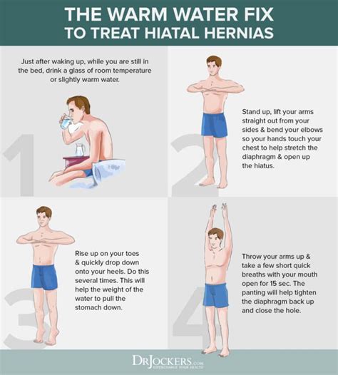 Exercises To Reduce Hernia Without Surgery Exercise Poster