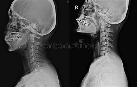 Cervical spondylosis is a very common disorder. Cervical Spondylosis With Disc Herniation ( MRI Of ...