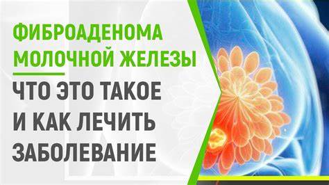 Фиброаденома молочной железы диета Фиброаденома молочной железы - YouTube Фиброаденома молочной железы - YouTube Фиброаденома молочной железы диета