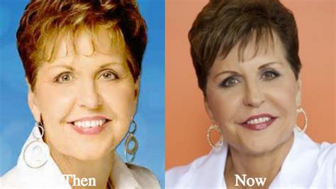 Joyce Meyer Plastic Surgery Before And After Photos