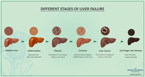 What Are The Different Stages Of Liver Failure