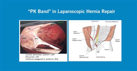 Pk Band In Laparoscopic Hernia Repair Dr R Padmakumar