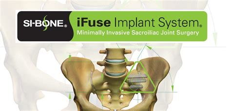 Si Bone Inc Announces Published Guidance Recommendation For Minimally