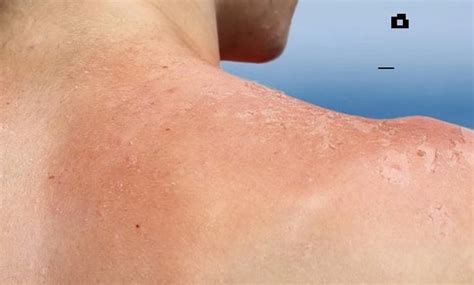 How To Get Rid Of Peeling Skin After Sunburn Natural Remedies For