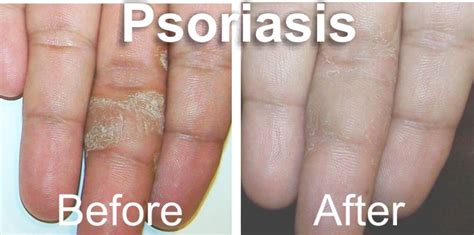 Homeoconsult Rd Psoriasis Homeopathy Treatment Medicine Mumbai