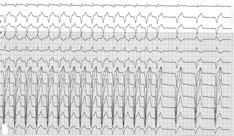 Pacemaker Mediated Tachycardia Microport Academy