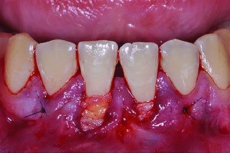 Following Application Of Emd A Palatal Connective Tissue Graft Was