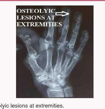 Figure From A Case Of A Typical Juvenile Hyaline Fibromatosis