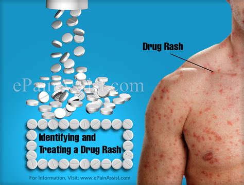 Identifying And Treating A Drug Rash