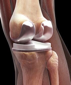 You definitely have to consider a lot before buying, so searching for this is what most customers do before making any purchase. Full Knee Replacement Surgery