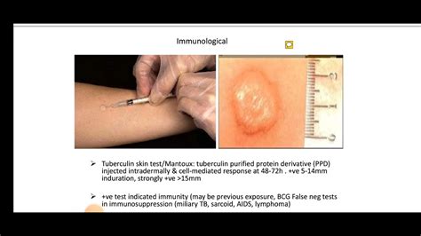 Tuberculin Skin Test Mantoux Test Youtube
