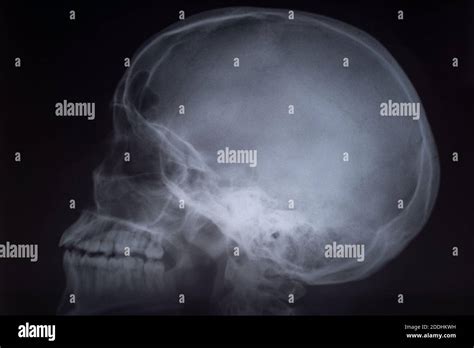 Lateral Xray Of Head Hi Res Stock Photography And Images Alamy