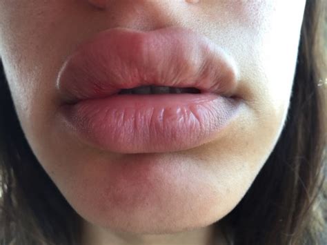 big lips with juvederm are not always better lips orange county ca