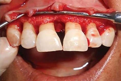 Gum Surgery Dentist In Jamnagar