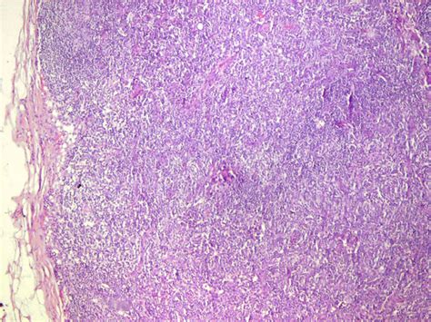 Angioimmunoblastic T Cell Lymphoma Pathophysiology Wikidoc