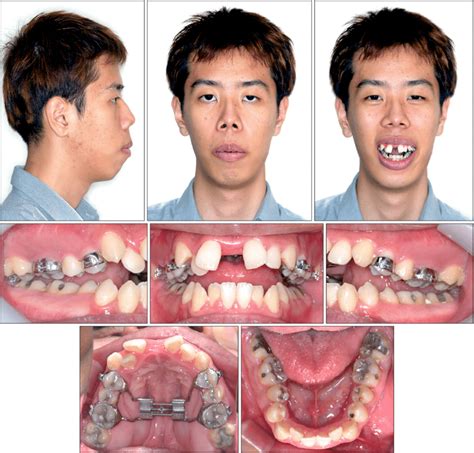 Palate Expander Before And After