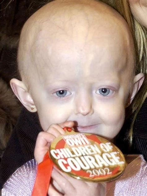 Hayley Okines Progeria Campaigner With The Body Of A 100 Year Old