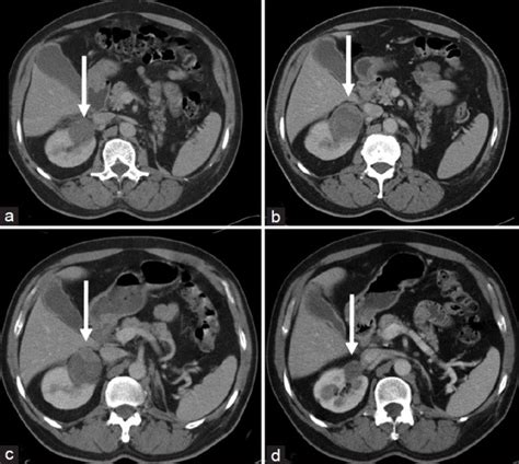Contrast Enhanced Ct Scan Depicting Renal Mass Or Ablation Site White