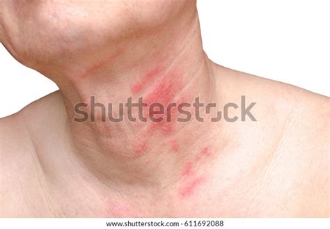Skin Inflammation Ulcer Caused By Insect Stock Photo Edit Now 611692088