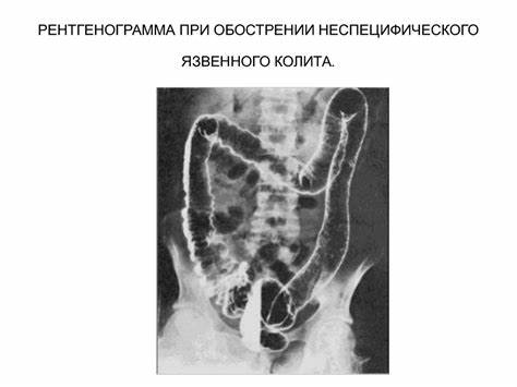 Диета при неспецифического язвенного колита Лучевые исследования при заболеваниях желудочно-кишечного тракта Лучевые исследования при заболеваниях желудочно-кишечного тракта Диета при неспецифического язвенного колита