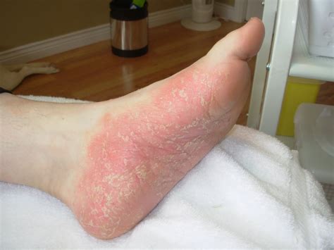 Foot Psoriasis The Complete Diagnosis And Treatment Guide