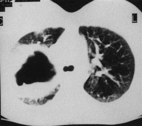 Giant Hydatid Cysts Of The Lung The Journal Of Thoracic And