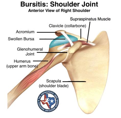 Shoulder Tendonitis The Orthopedic And Sports Medicine Institute In