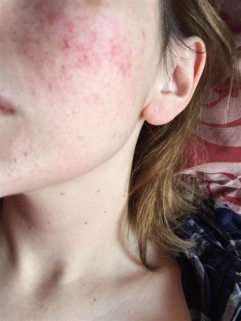 Routine Help For Years My Skin Has This Red Bumpy Area In The Middle