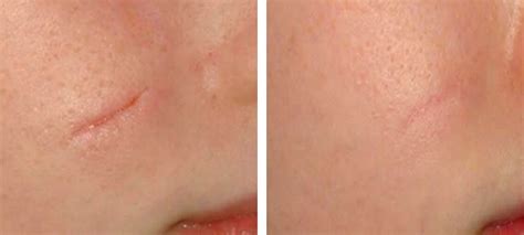 Visible Scars Treatment Before And After Kingsway Dermatology