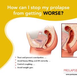 How To Fix A Prolapsed Rectum Without Surgery