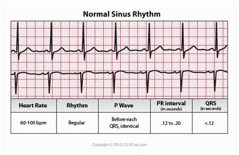 Ekg Ecg Interpretation In 2022 Normal Sinus Rhythm Nurse Ecg