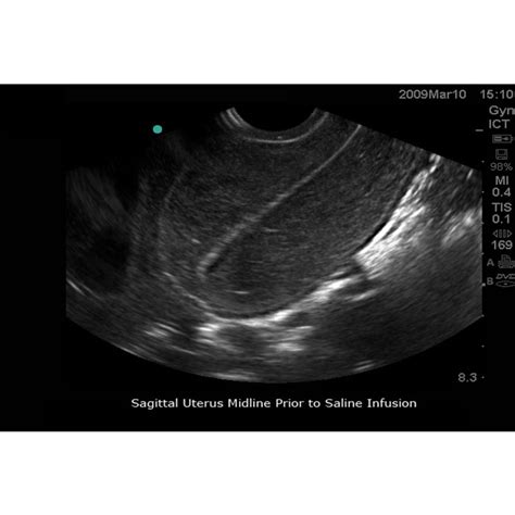 abp sonohysterography sonosalpingography transvaginal ultrasound hot sex picture