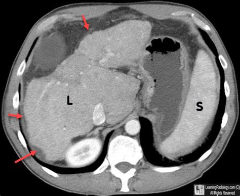 Learning Radiology Cirrhosis Imaging Ascites