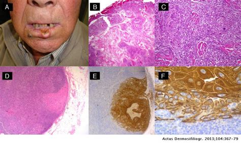 Cutaneous Squamous Cell Carcinoma Defining The High Risk Variant