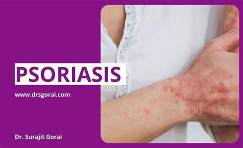 Psoriasis Not Just Skin Disease