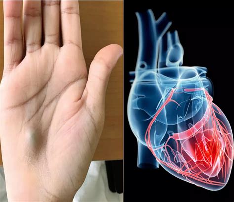 Bulging Lump On Palm Revealed Serious Heart Infection Everyone Must