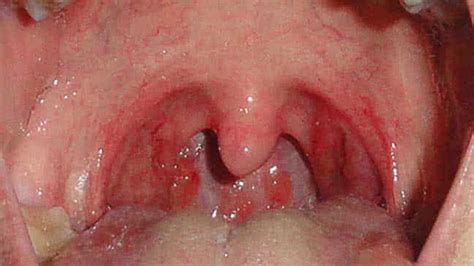 Strep Throat Symptoms Causes Treatment And More