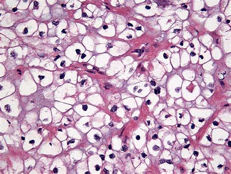 Current Pathology Keys Of Renal Cell Carcinoma European Urology
