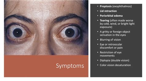 Underactive Thyroid Symptoms Eye Problems