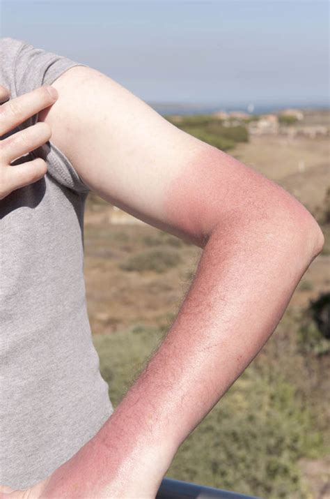 Sunburn Warning Britons Dismiss Skin Damage As Inevitable Price Of