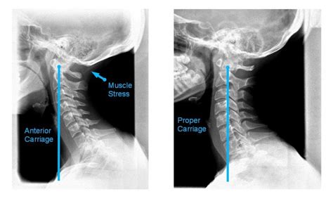 Why Does Posture Really Matter Innova Pain Clinicinnova Pain Clinic