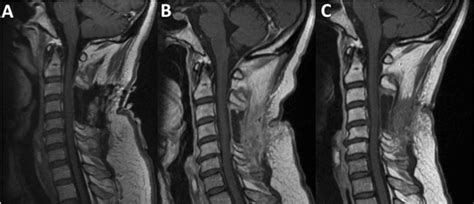 T1 Weighted Mri Of The Cervical Spine With Contrast At Initial A