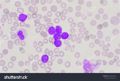 Group Blast Cells Leukemia Blood Smear Stock Photo Edit Now 1829423318
