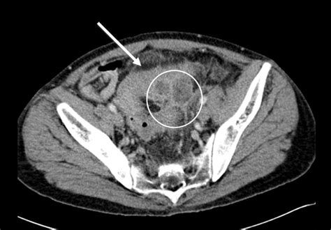 A Sigmoid Diverticulitis With Abscess Formation Sigmoid Colon