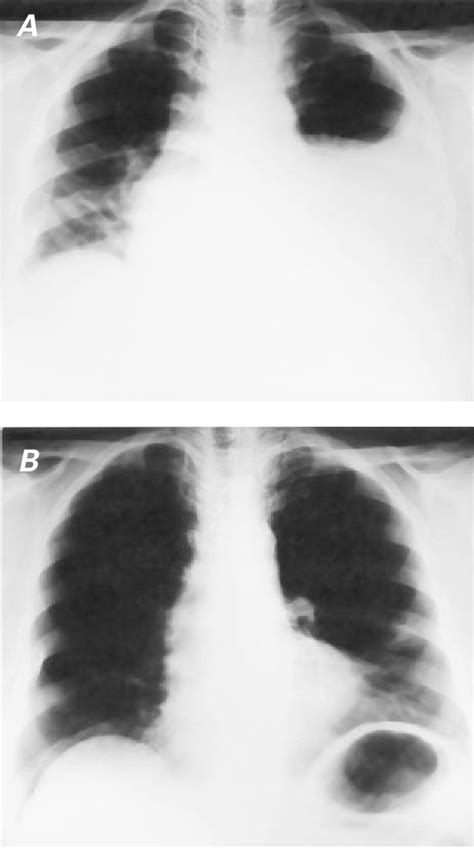 Figure 1 From Octreotide For Treating Chylothorax After Cardiac Surgery
