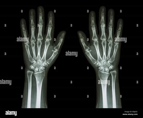 X Ray Normal Hand High Resolution Stock Photography And Images Alamy