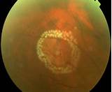 Images of Treatment For Hole In Retina Of Eye