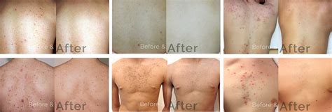 Back Acne Treatment Safe And Effective Back Acne Treatment